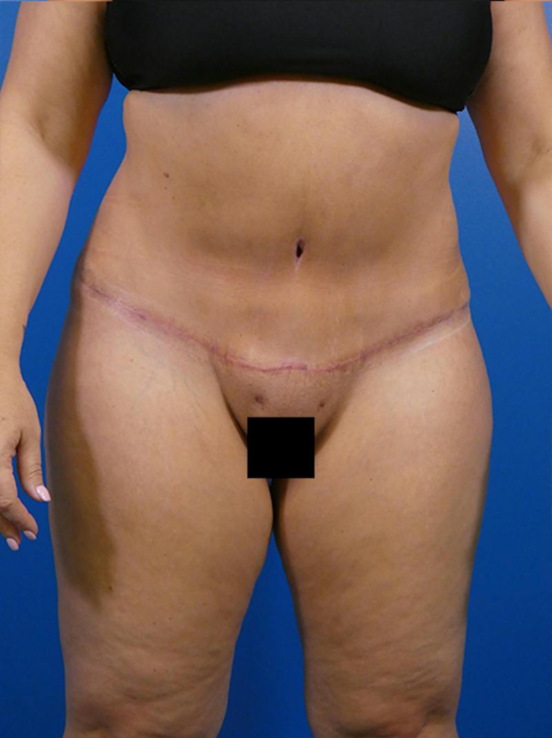 Tummy Tuck Before & After Gallery - Patient 275053 - Image 2