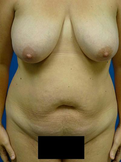 Tummy Tuck Before & After Gallery - Patient 105112 - Image 1