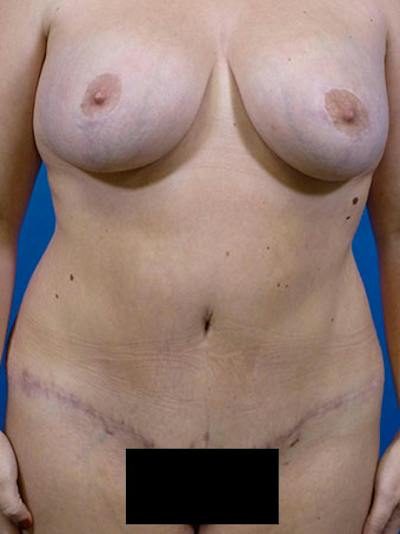 Tummy Tuck Before & After Gallery - Patient 105112 - Image 2