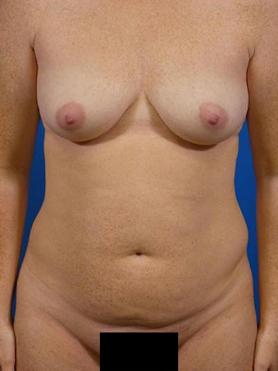 Tummy Tuck Before & After Gallery - Patient 615627 - Image 1