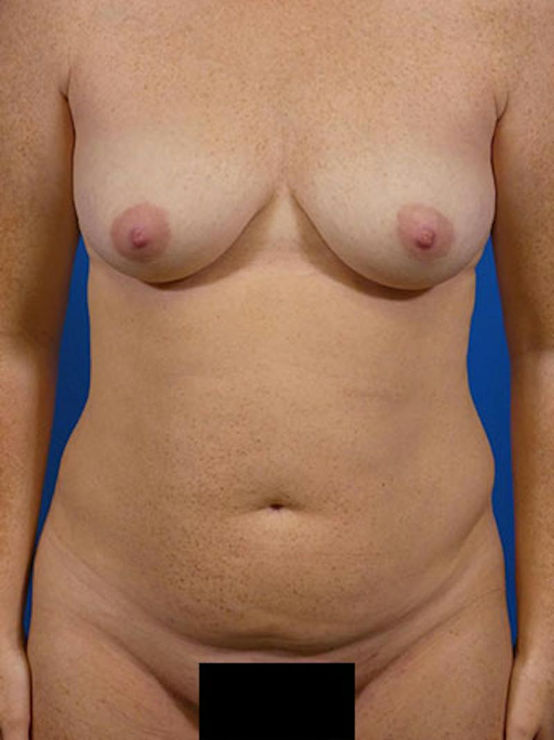 Tummy Tuck Before & After Gallery - Patient 615627 - Image 1
