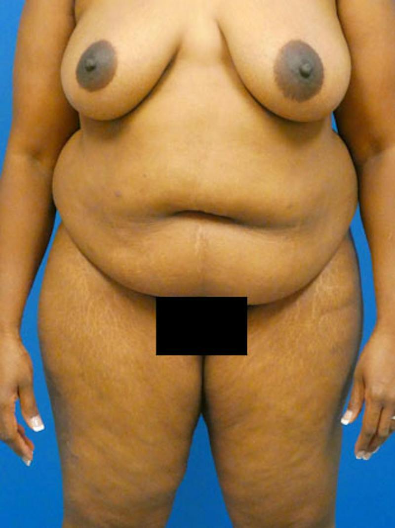Tummy Tuck Before & After Gallery - Patient 338490 - Image 1