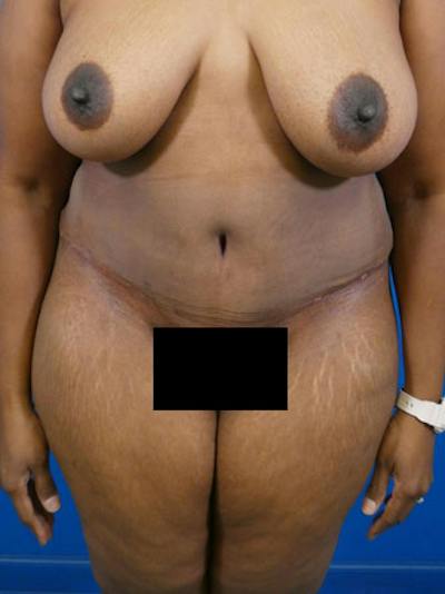 Tummy Tuck Before & After Gallery - Patient 338490 - Image 2