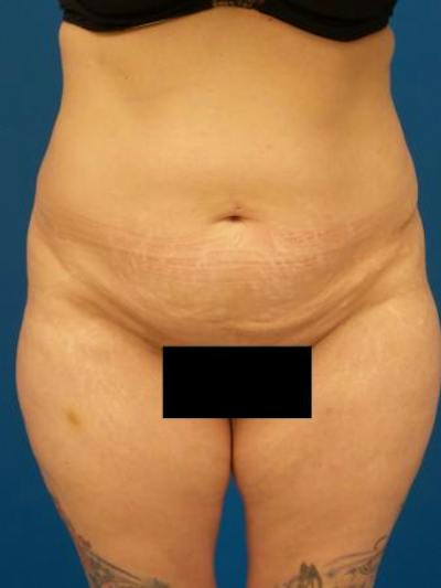Tummy Tuck Before & After Gallery - Patient 389792 - Image 1