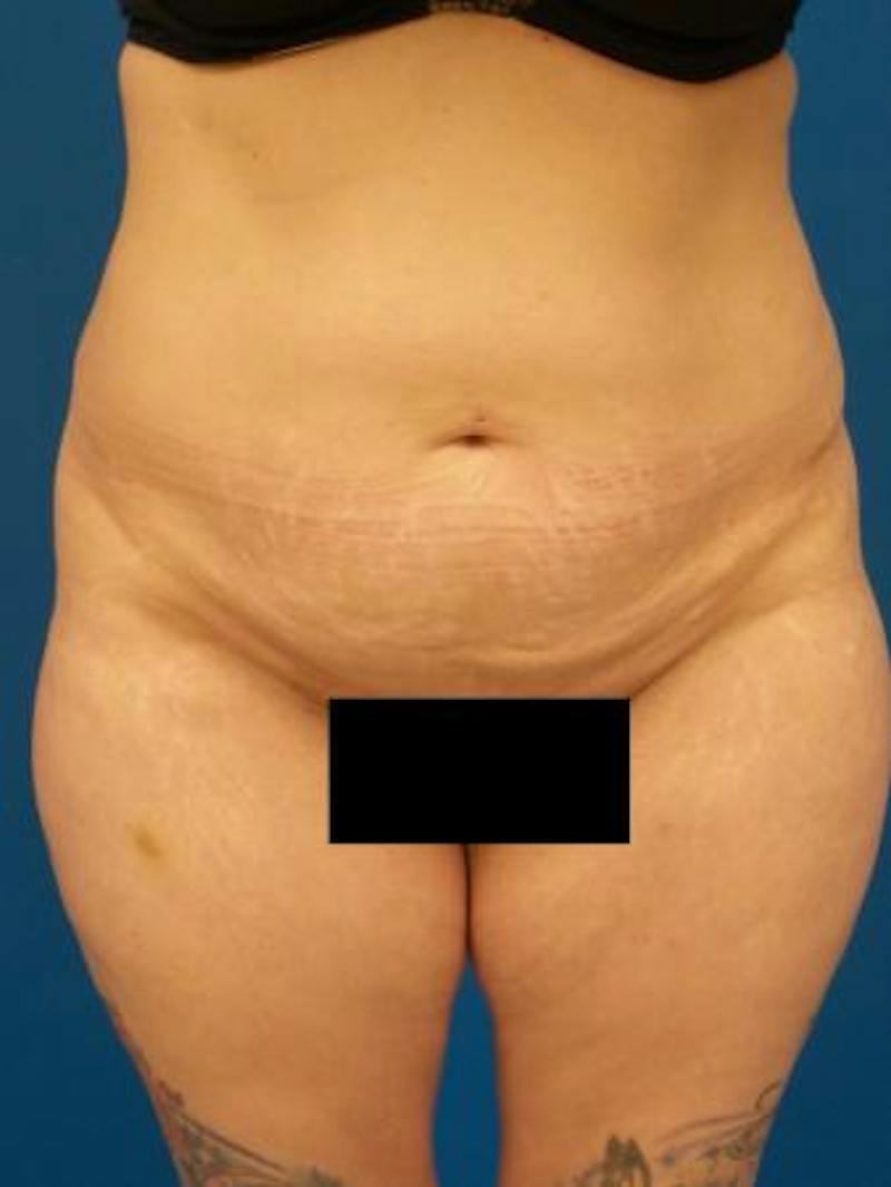 Tummy Tuck Before & After Gallery - Patient 389792 - Image 1