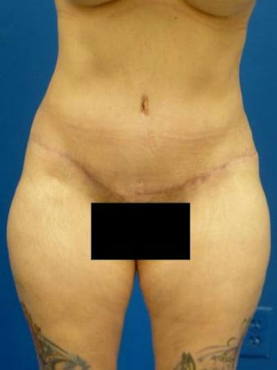 Tummy Tuck Before & After Gallery - Patient 389792 - Image 2