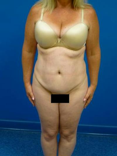 Tummy Tuck Before & After Gallery - Patient 284048 - Image 1