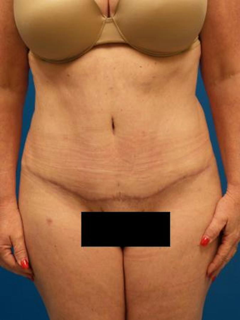 Tummy Tuck Before & After Gallery - Patient 284048 - Image 2