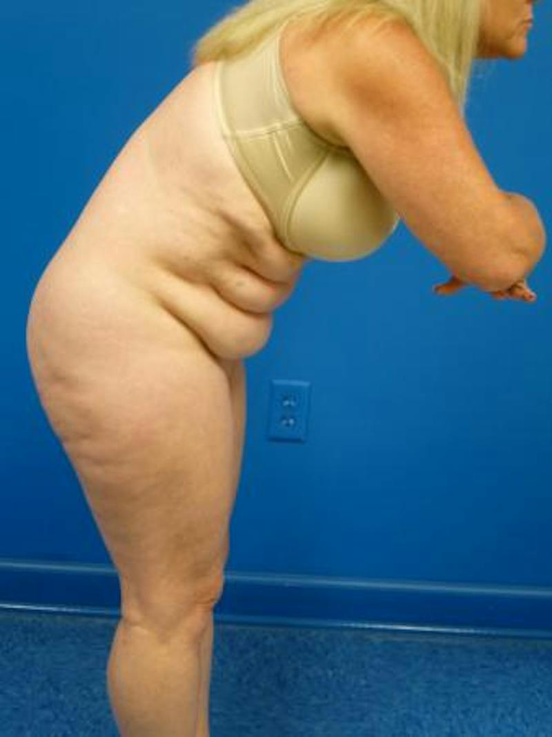 Tummy Tuck Before & After Gallery - Patient 284048 - Image 3