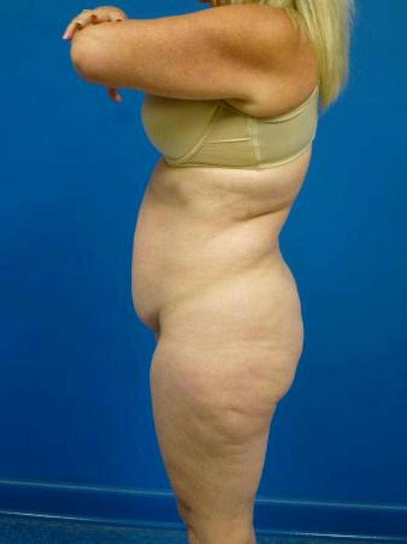 Tummy Tuck Before & After Gallery - Patient 284048 - Image 5