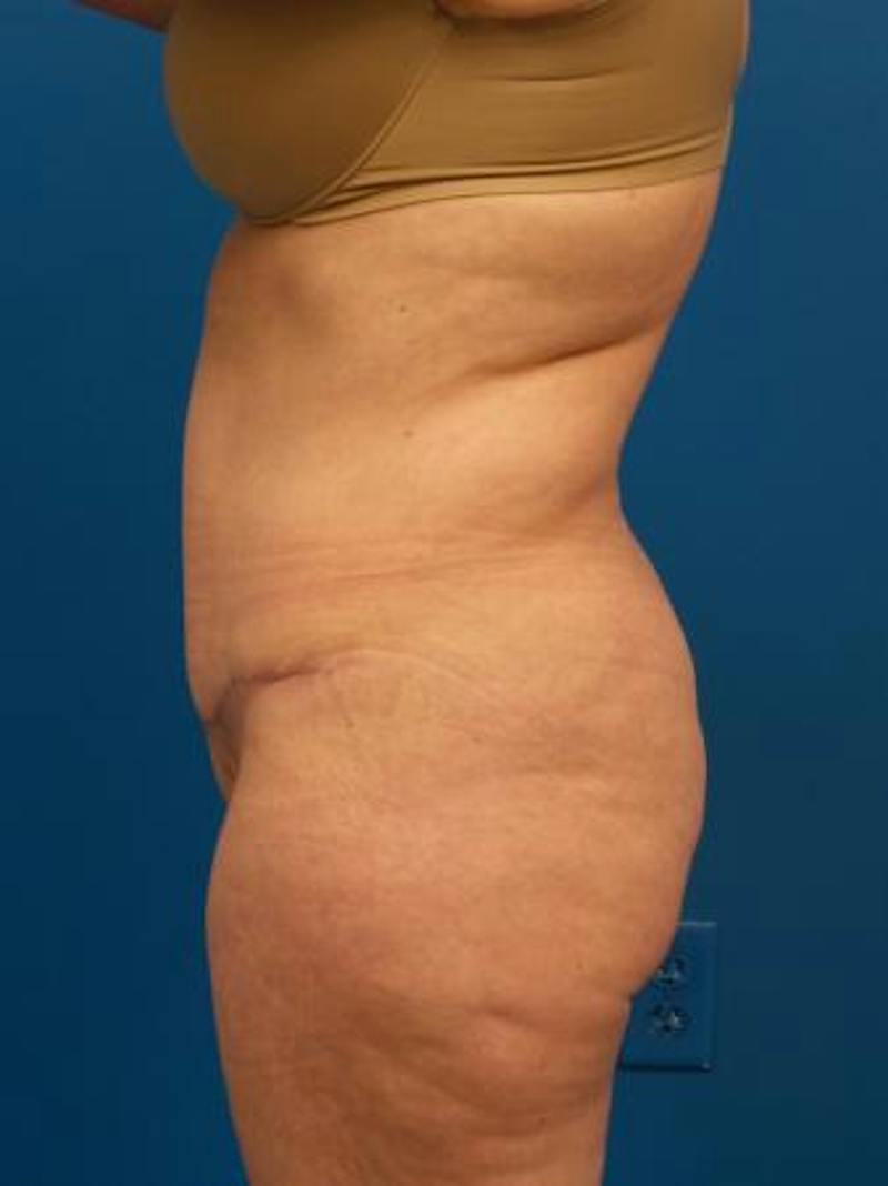 Tummy Tuck Before & After Gallery - Patient 284048 - Image 6