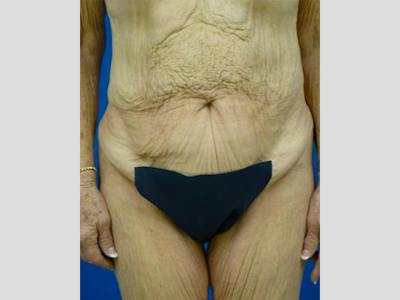 Tummy Tuck Before & After Gallery - Patient 403282 - Image 1