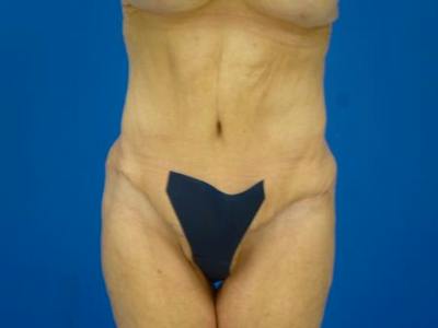 Tummy Tuck Before & After Gallery - Patient 403282 - Image 2