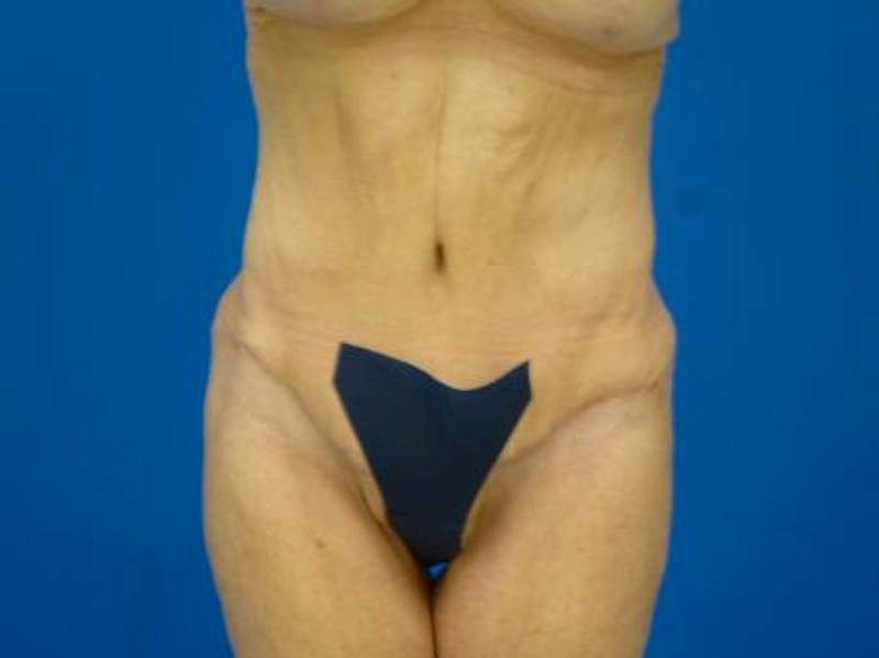 Tummy Tuck Before & After Gallery - Patient 403282 - Image 2