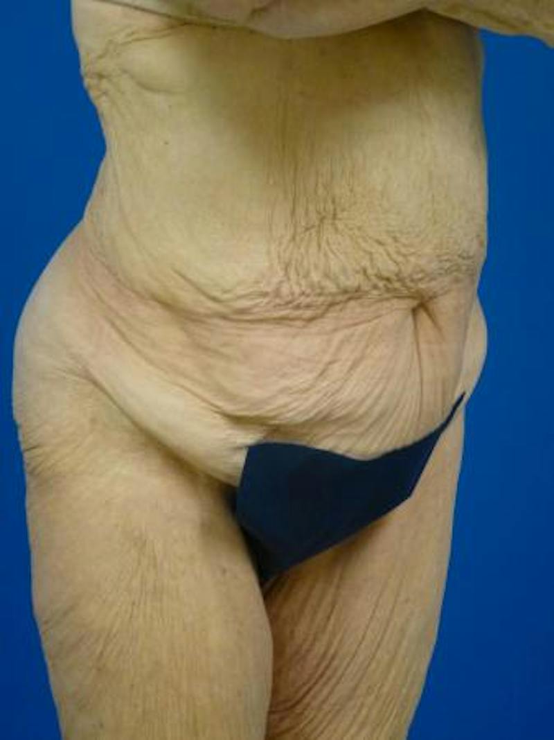 Tummy Tuck Before & After Gallery - Patient 403282 - Image 3