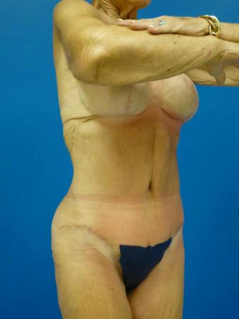 Tummy Tuck Before & After Gallery - Patient 403282 - Image 4