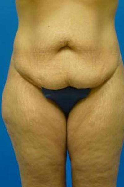 Tummy Tuck Before & After Gallery - Patient 721255 - Image 1