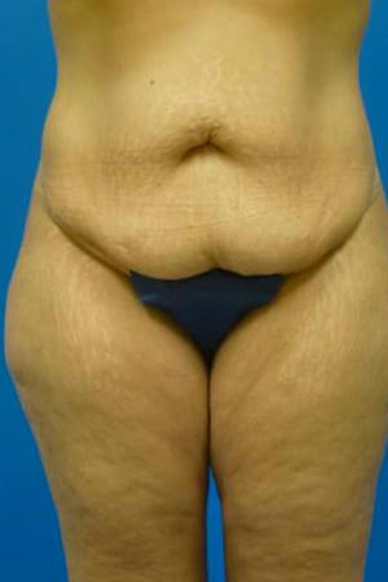 Tummy Tuck Before & After Gallery - Patient 721255 - Image 1