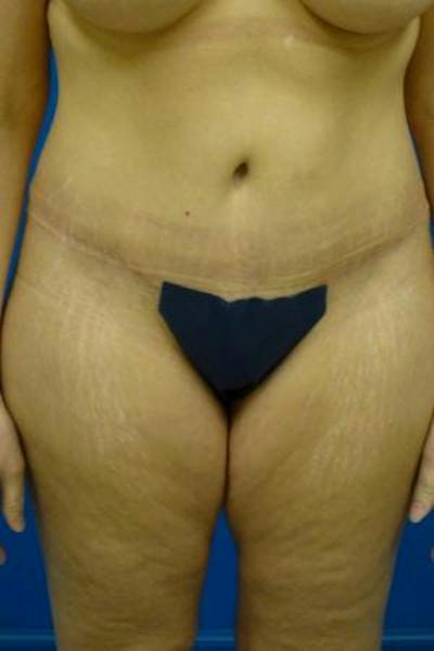 Tummy Tuck Before & After Gallery - Patient 721255 - Image 2