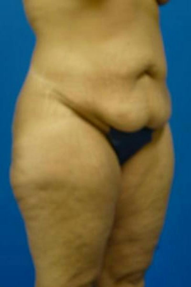 Tummy Tuck Before & After Gallery - Patient 721255 - Image 3