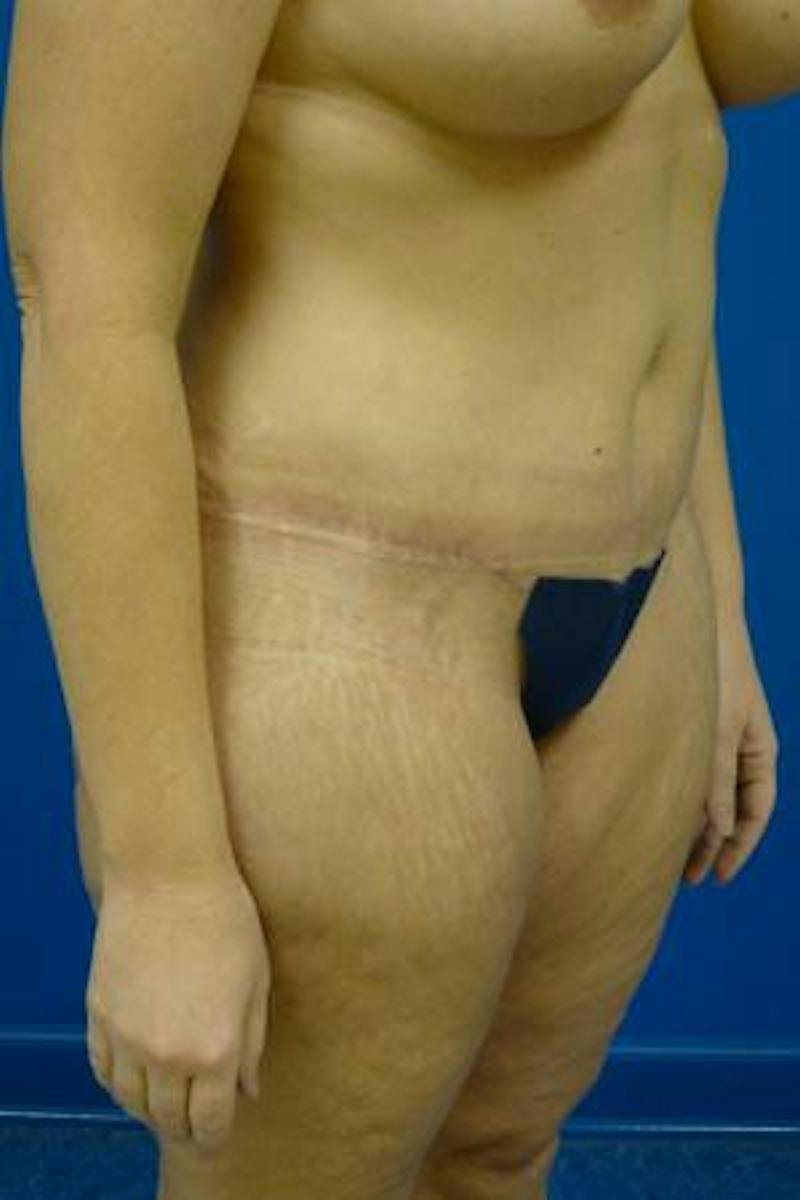 Tummy Tuck Before & After Gallery - Patient 721255 - Image 4