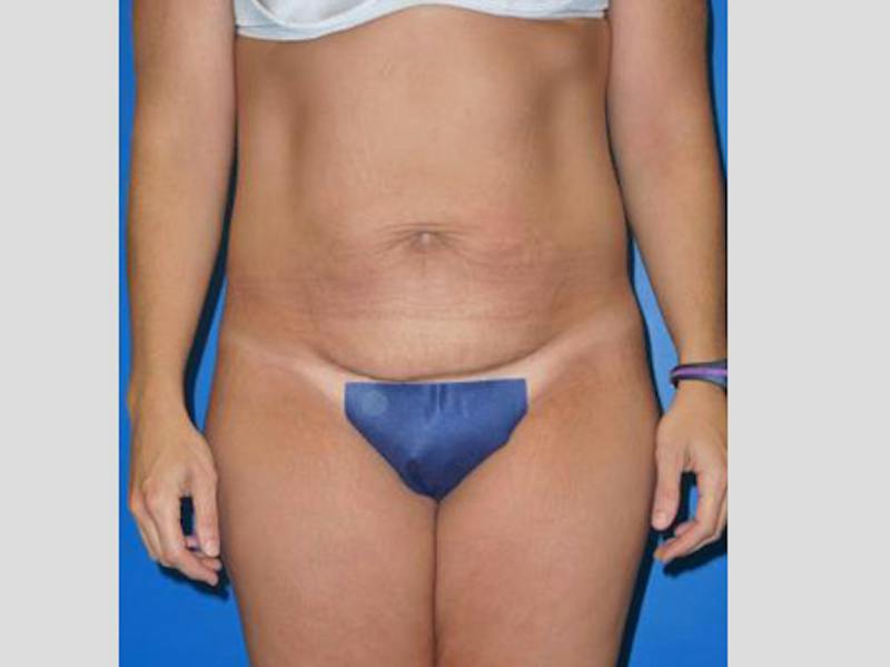 Tummy Tuck Before & After Gallery - Patient 129212 - Image 1