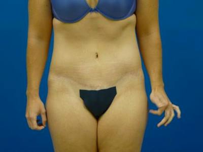 Tummy Tuck Before & After Gallery - Patient 129212 - Image 2