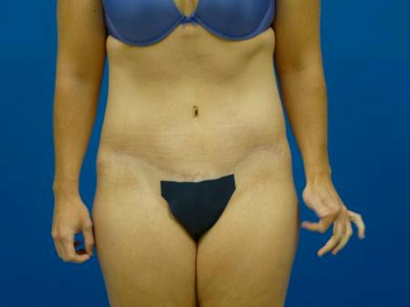 Tummy Tuck Before & After Gallery - Patient 129212 - Image 2