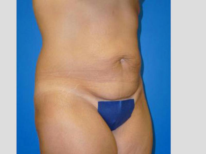 Tummy Tuck Before & After Gallery - Patient 129212 - Image 3