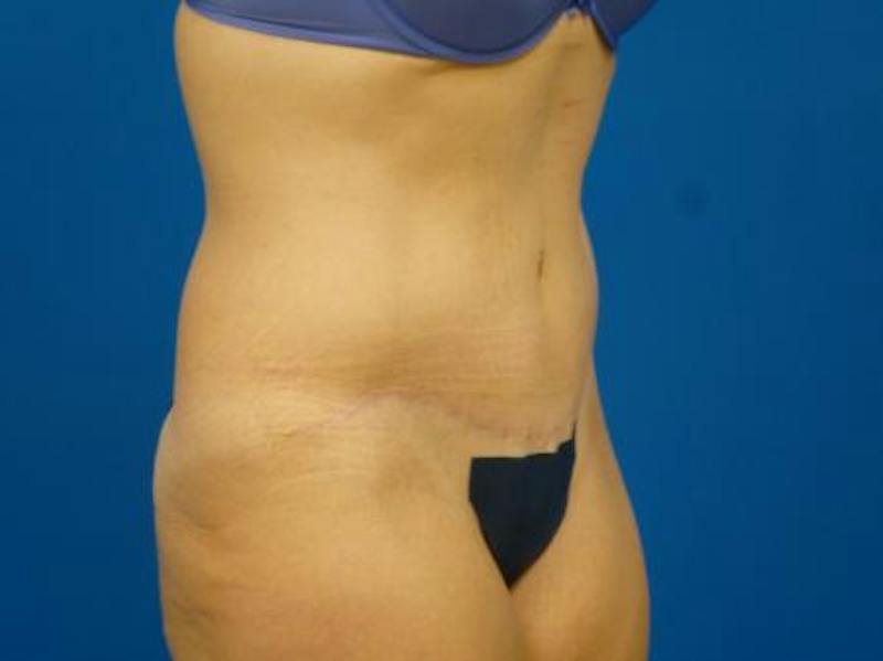 Tummy Tuck Before & After Gallery - Patient 129212 - Image 4