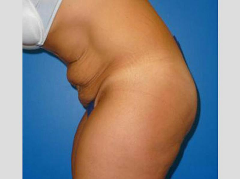 Tummy Tuck Before & After Gallery - Patient 129212 - Image 5