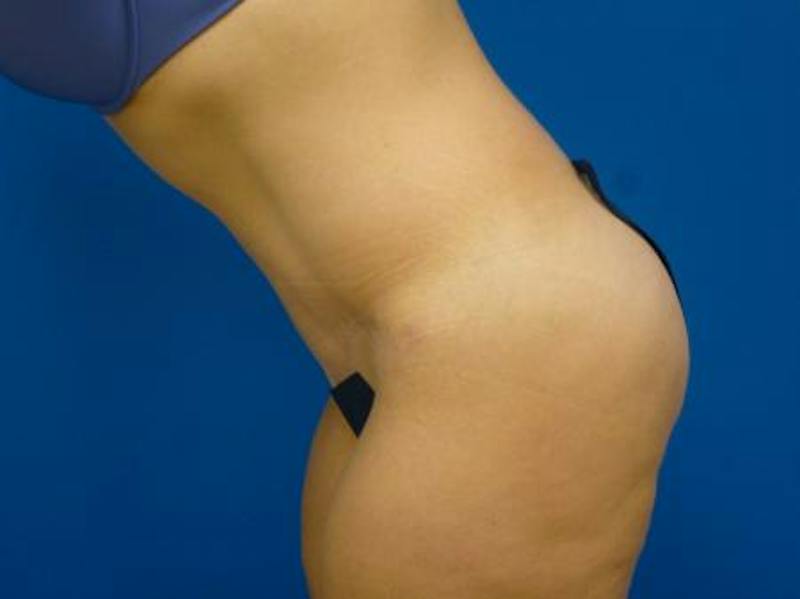 Tummy Tuck Before & After Gallery - Patient 129212 - Image 6