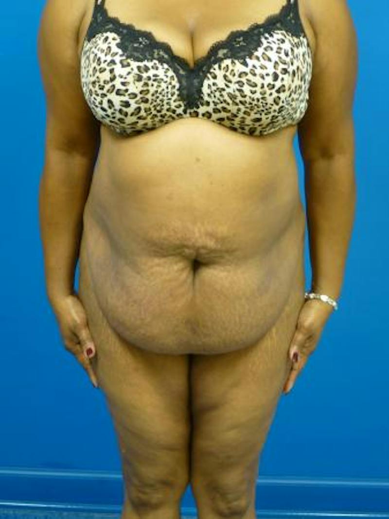 Tummy Tuck Before & After Gallery - Patient 122104 - Image 1