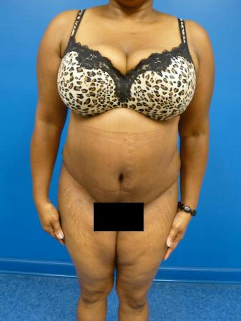 Tummy Tuck Before & After Gallery - Patient 122104 - Image 2