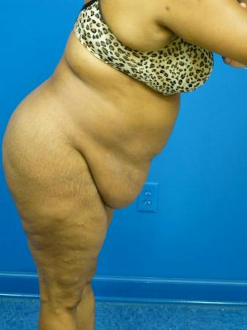 Tummy Tuck Before & After Gallery - Patient 122104 - Image 3