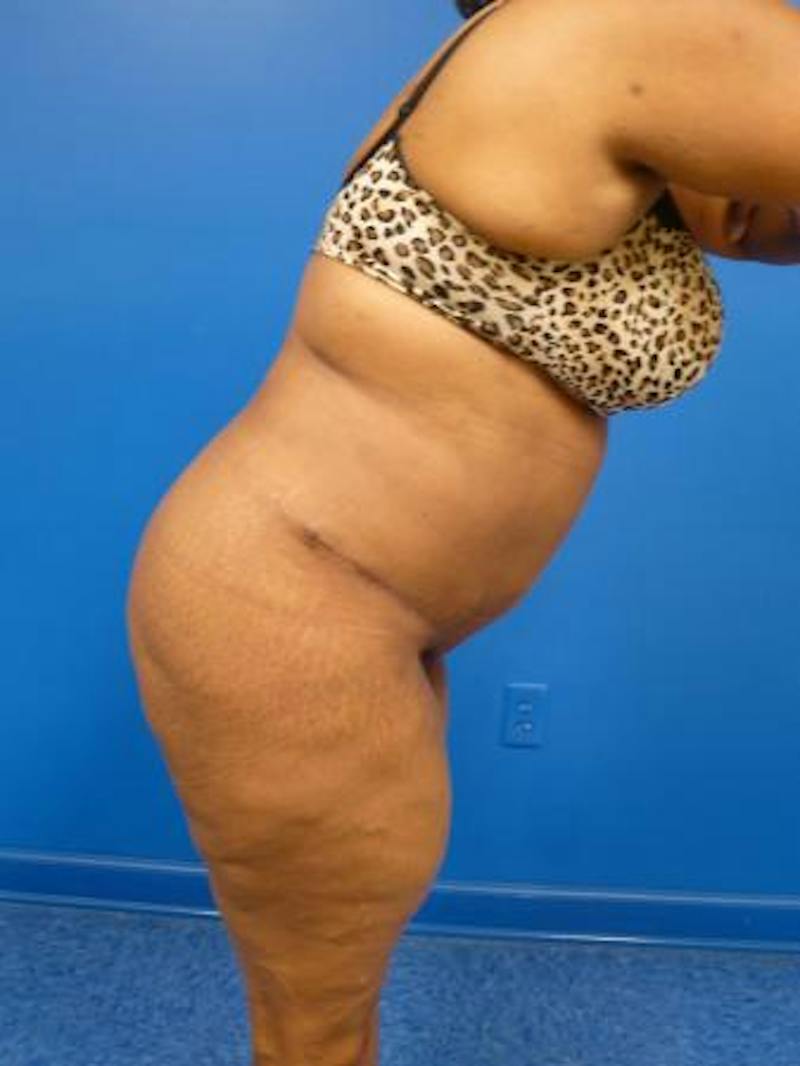 Tummy Tuck Before & After Gallery - Patient 122104 - Image 4
