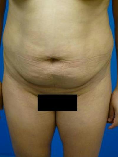 Tummy Tuck Before & After Gallery - Patient 259019 - Image 1