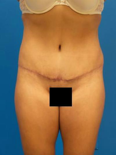Tummy Tuck Before & After Gallery - Patient 259019 - Image 2