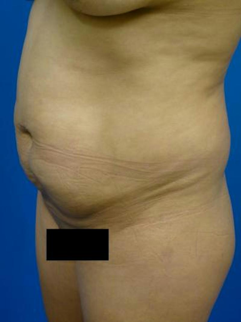 Tummy Tuck Before & After Gallery - Patient 259019 - Image 3
