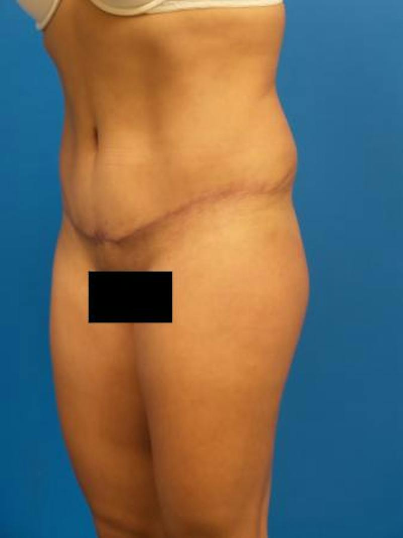 Tummy Tuck Before & After Gallery - Patient 259019 - Image 4