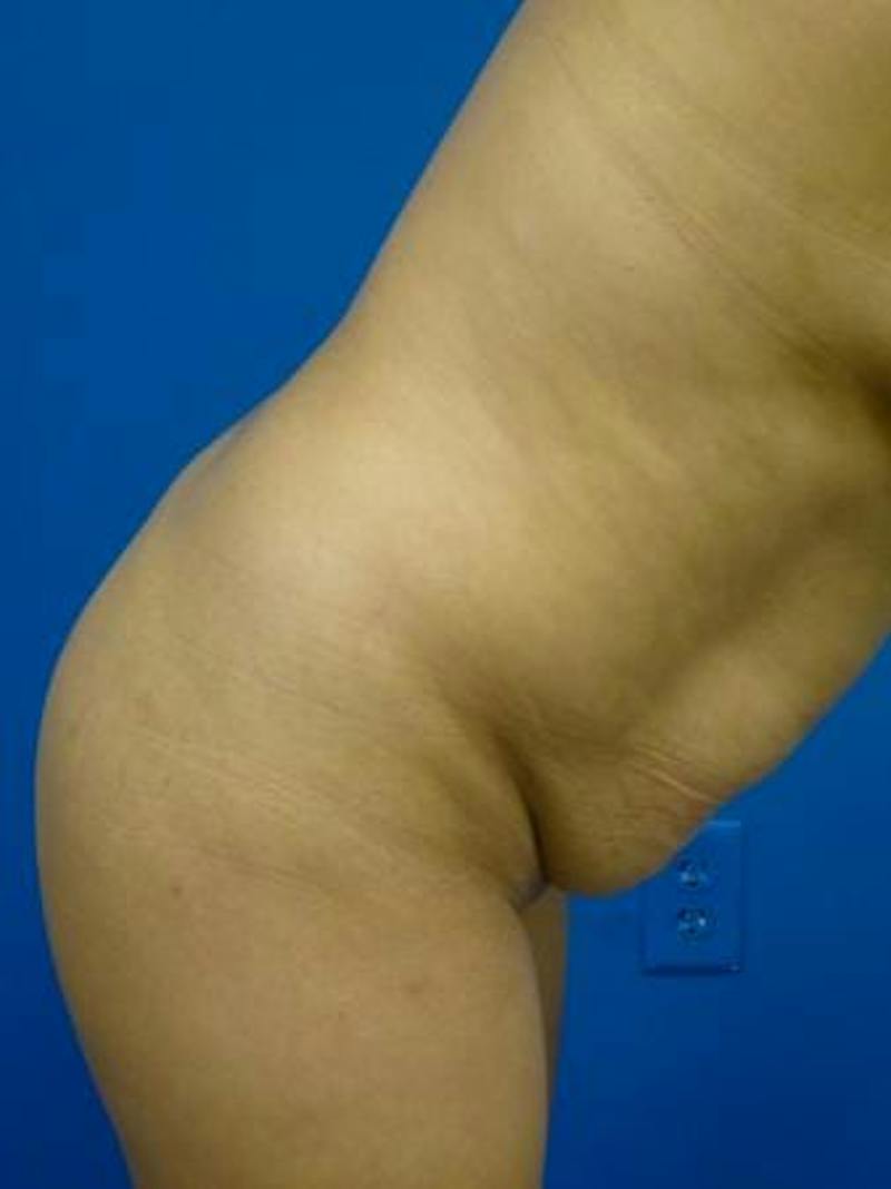 Tummy Tuck Before & After Gallery - Patient 259019 - Image 5