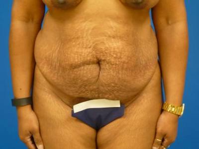 Tummy Tuck Before & After Gallery - Patient 133594 - Image 1