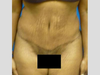 Tummy Tuck Before & After Gallery - Patient 133594 - Image 2