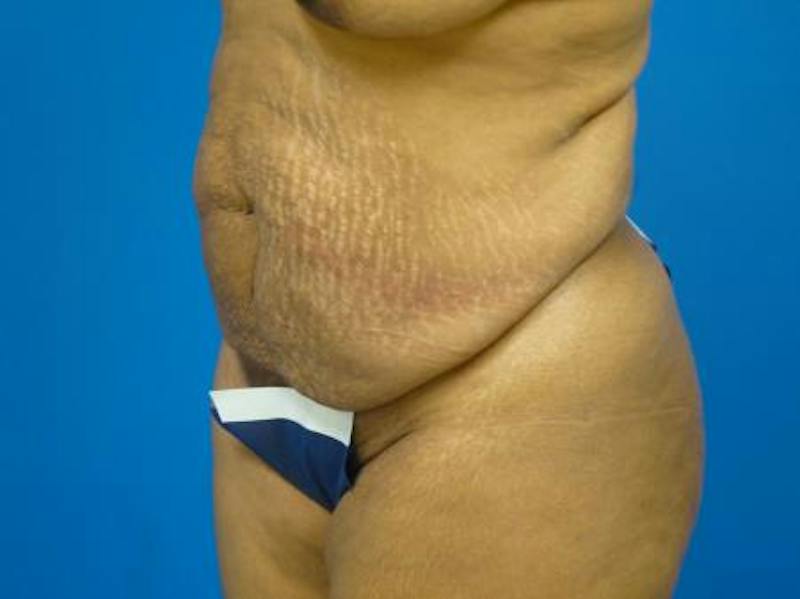 Tummy Tuck Before & After Gallery - Patient 133594 - Image 3