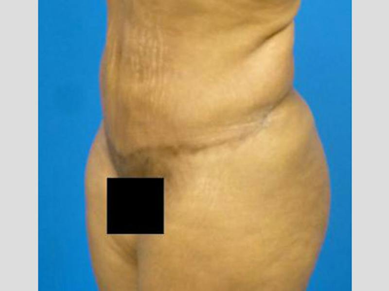 Tummy Tuck Before & After Gallery - Patient 133594 - Image 4