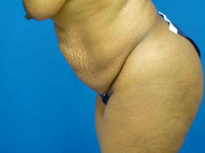 Tummy Tuck Before & After Gallery - Patient 133594 - Image 5