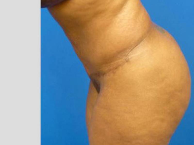 Tummy Tuck Before & After Gallery - Patient 133594 - Image 6