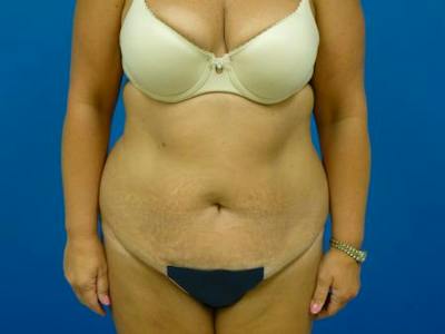 Tummy Tuck Before & After Gallery - Patient 112037 - Image 1