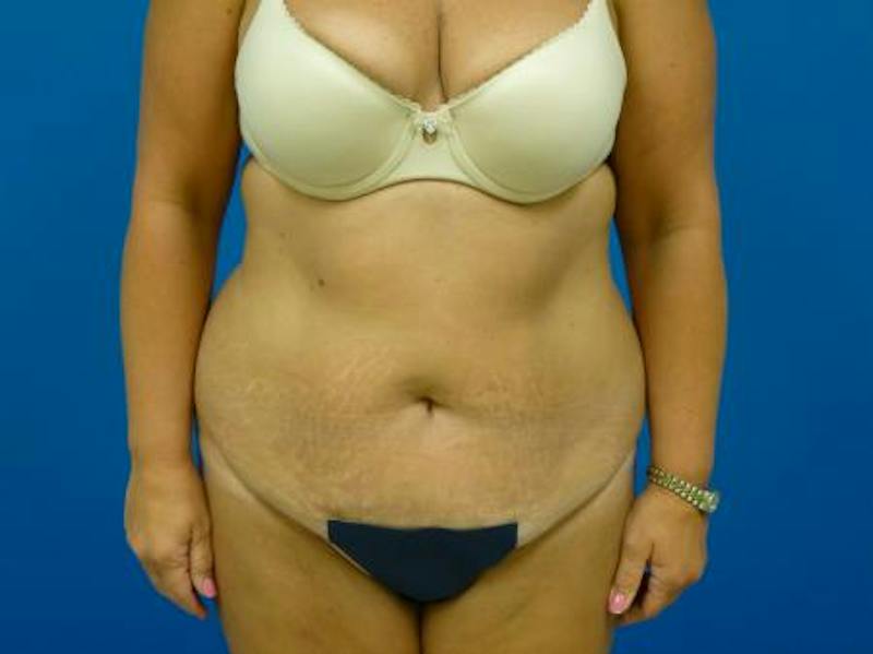 Tummy Tuck Before & After Gallery - Patient 112037 - Image 1