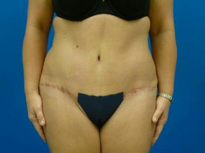 Tummy Tuck Before & After Gallery - Patient 112037 - Image 2